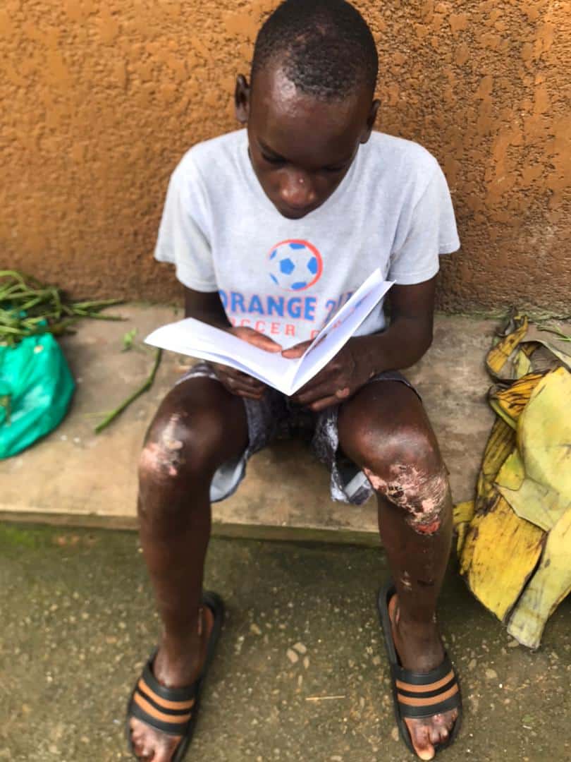 Eric sits on a bench reading a booklet, visible scarring on his legs from his skin condition.