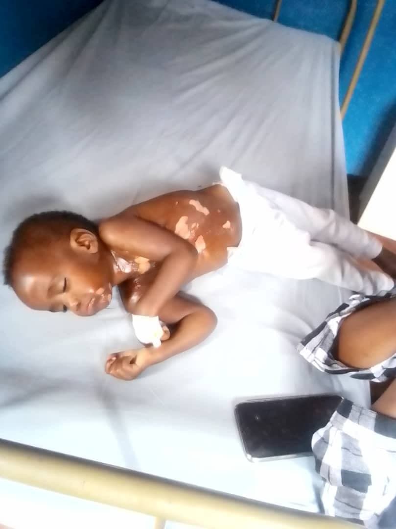 A young burned child lies on a hospital bed at Miracle Medical Center receiving care.